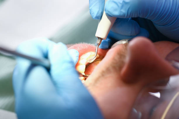 Best Emergency Tooth Extraction in Bellefonte, PA